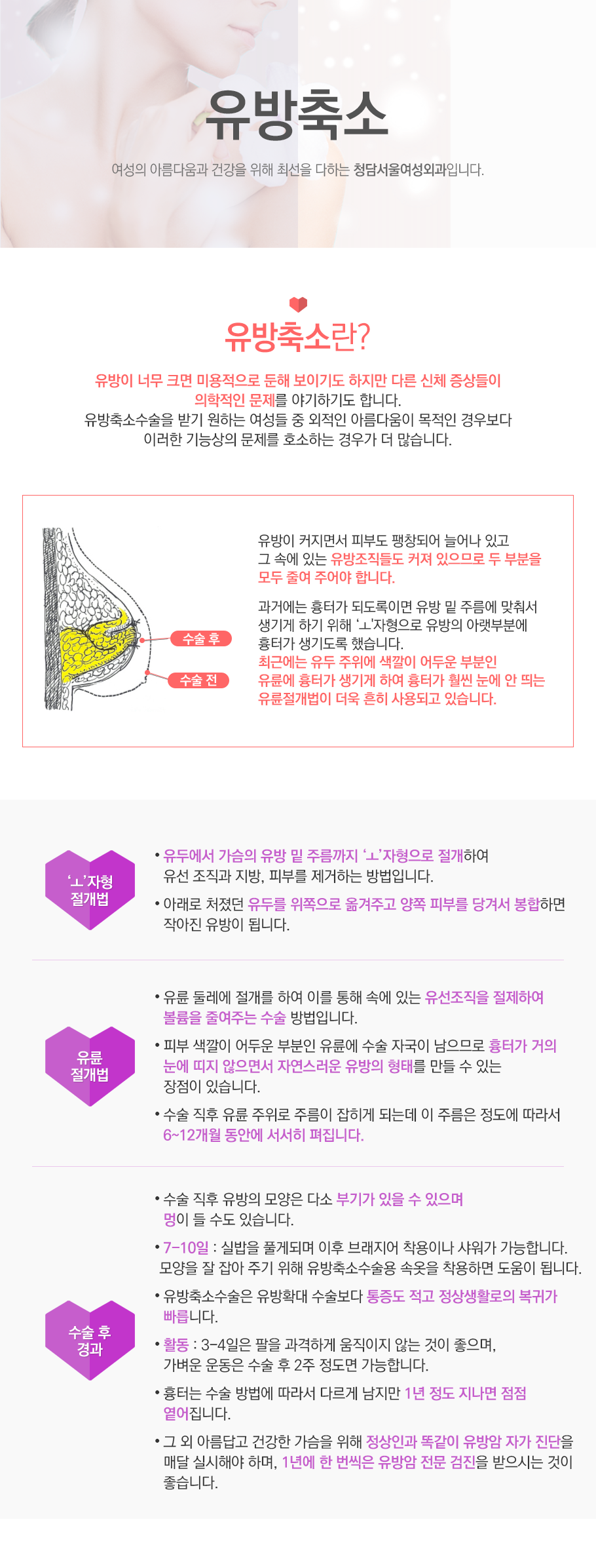 유방축소